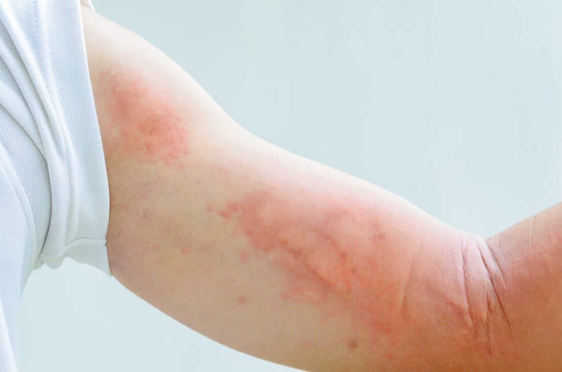 All about skin allergy you need to know
