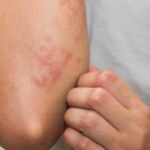 five common skin allergies