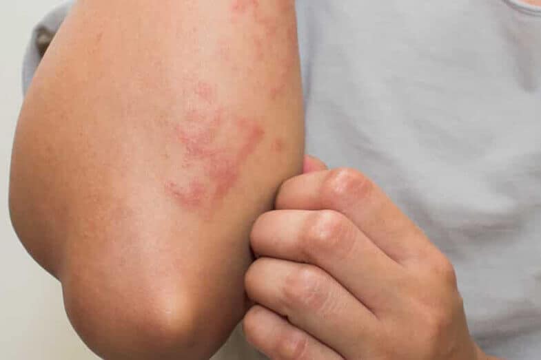 five common skin allergies