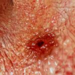lifestyleug.com__Can you die from a stomach ulcer (1)