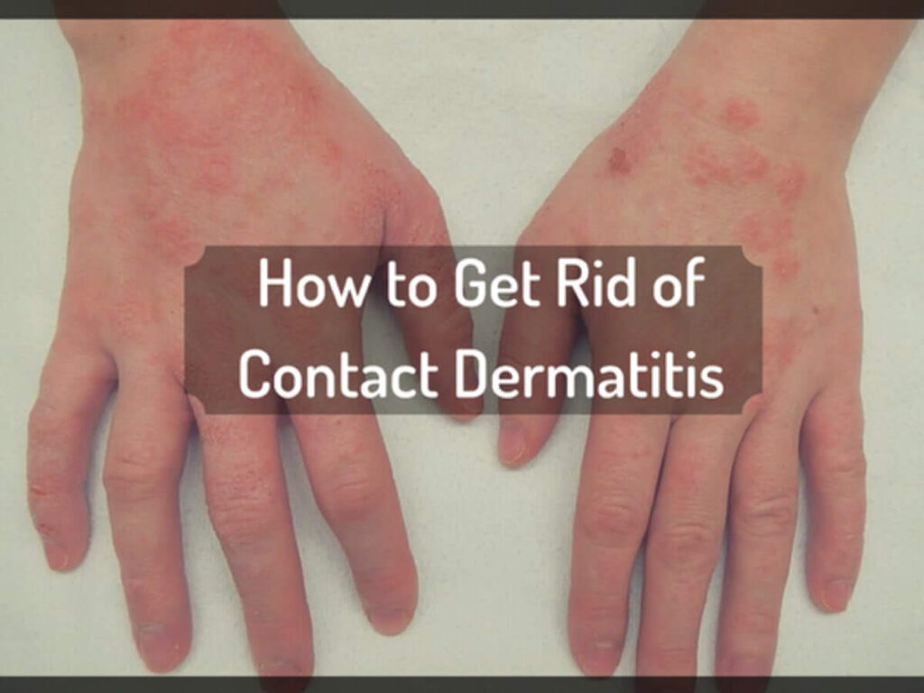 lifestyleug.com__symptom of contact dermatitis