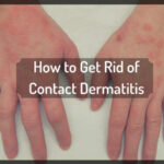 lifestyleug.com__symptom of contact dermatitis
