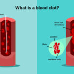 lifestyleug.com__Risk for Developing Blood Clots