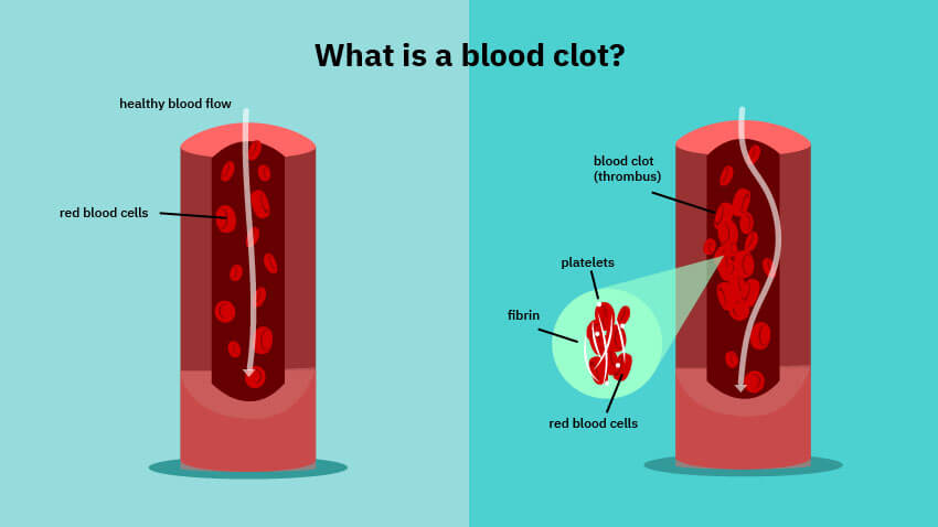 lifestyleug.com__Risk for Developing Blood Clots