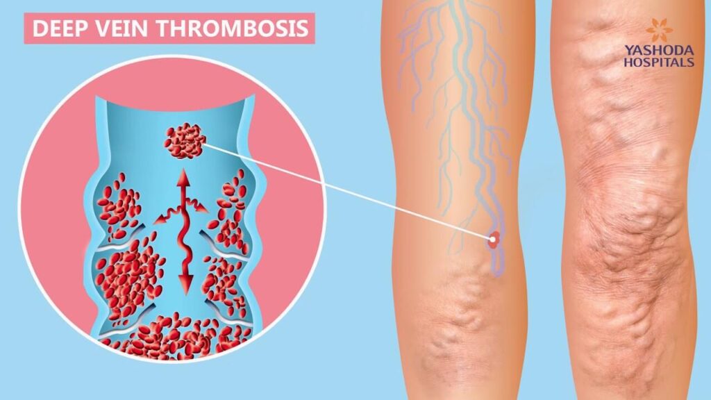 lifestyleug.com__treat and identify deep vein thrombosis and its types (1)