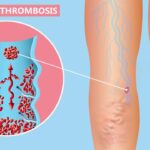 lifestyleug.com__treat and identify deep vein thrombosis and its types (1)