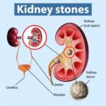 lifestyleug.com__developing treatment of kidney stones