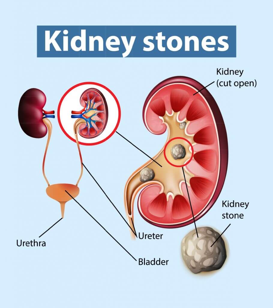 lifestyleug.com__developing treatment of kidney stones