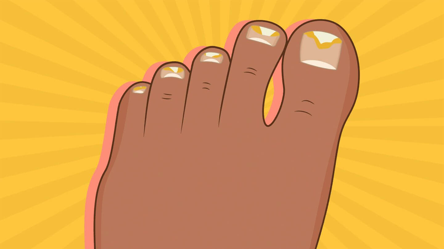 lifestyleug.com__What is toenail fungus