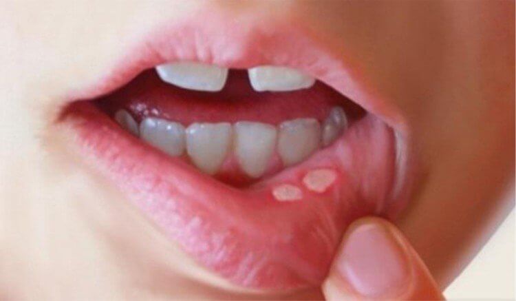 lifestyleug.com__Causes Mouth Sores After Oral Sex (1)