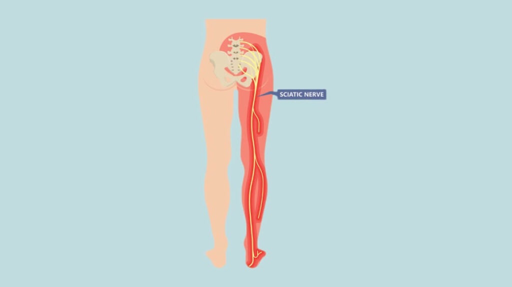 lifestyleug.com_symptoms and causes of sciatica nerve pain (1)