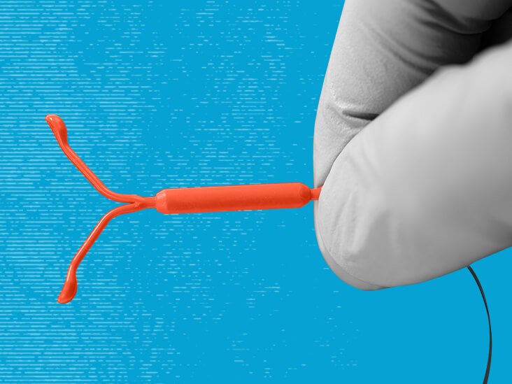 mirena IUD removal