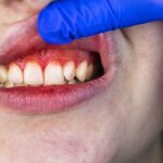 Gingivitis and periodontitis are both gum diseases