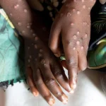 Africa CDC Warns of Mpox Hotspots as Over 25,000 Cases Confirmed.